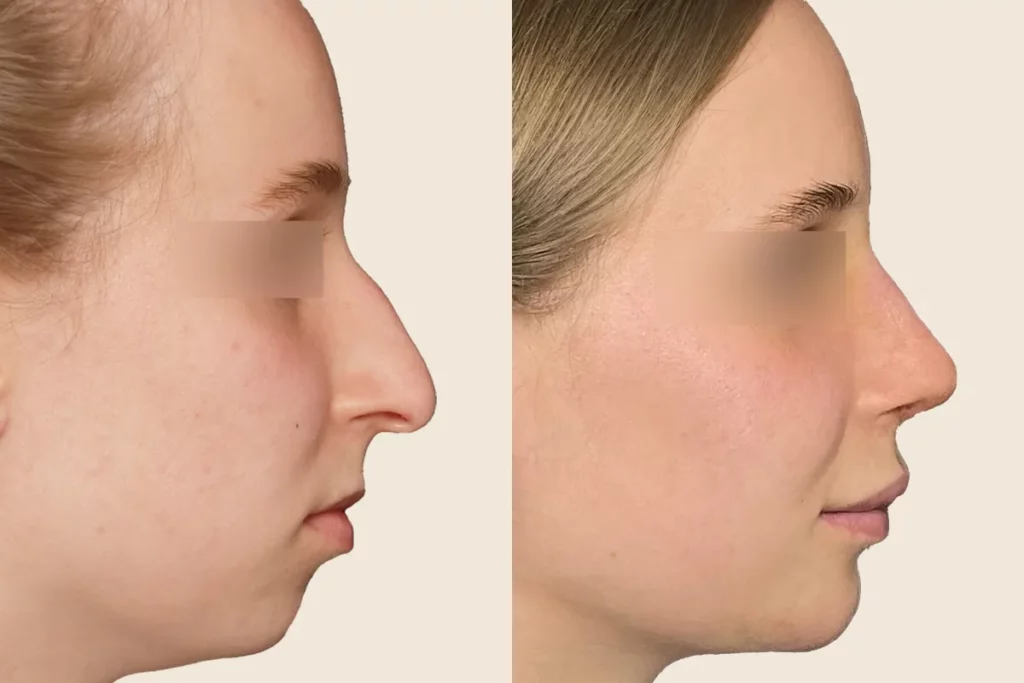 Profile photos of a patient after rhinoplasty in before and after comparison.