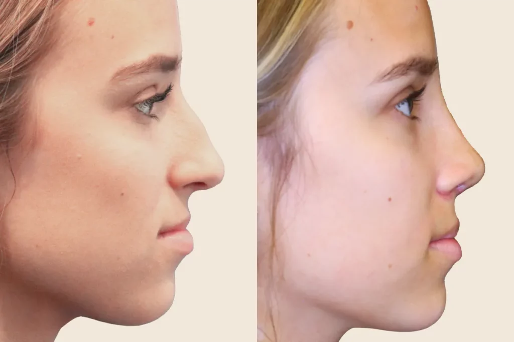 Profile photos of a patient after rhinoplasty in before and after comparison.