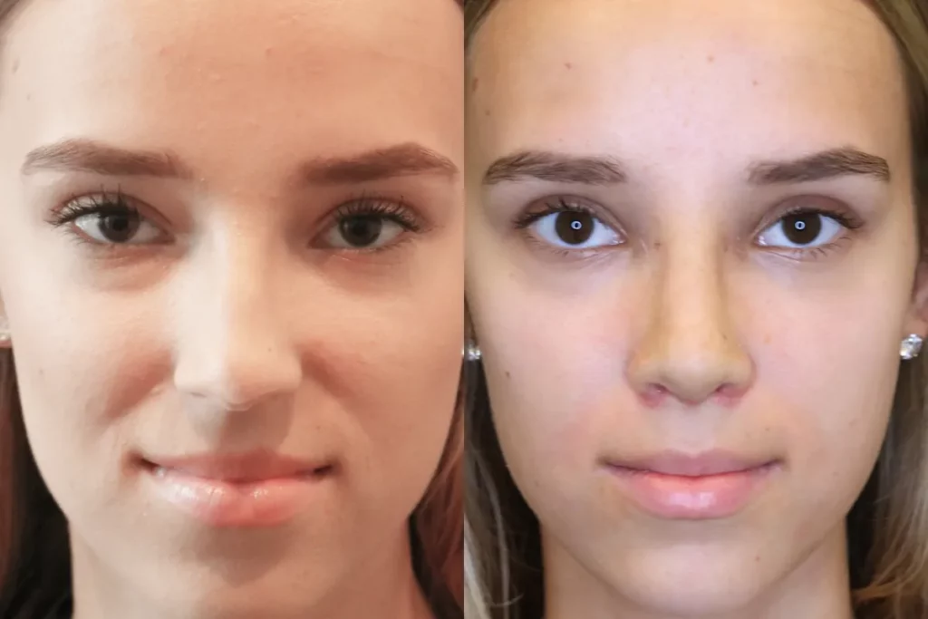 Portraits of a patient before and after rhinoplasty.