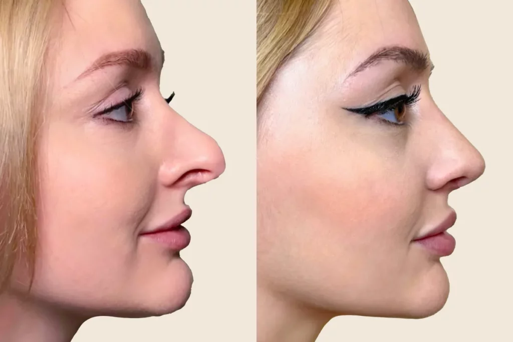 Profile photos of a patient after rhinoplasty in before and after comparison.