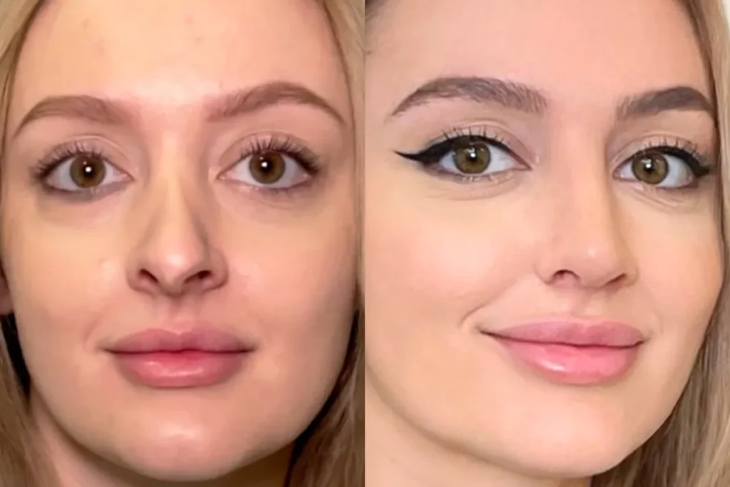 Portraits of a patient before and after rhinoplasty.