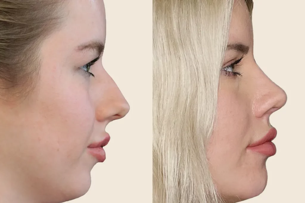 Profile photos of a patient after rhinoplasty in before and after comparison.