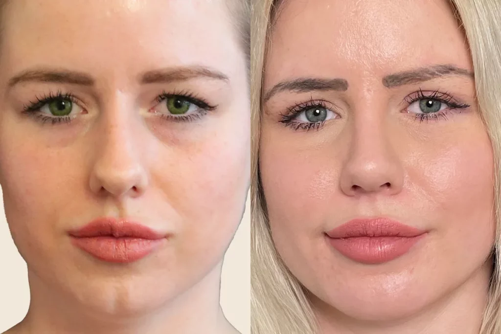 Portraits of a patient before and after rhinoplasty.