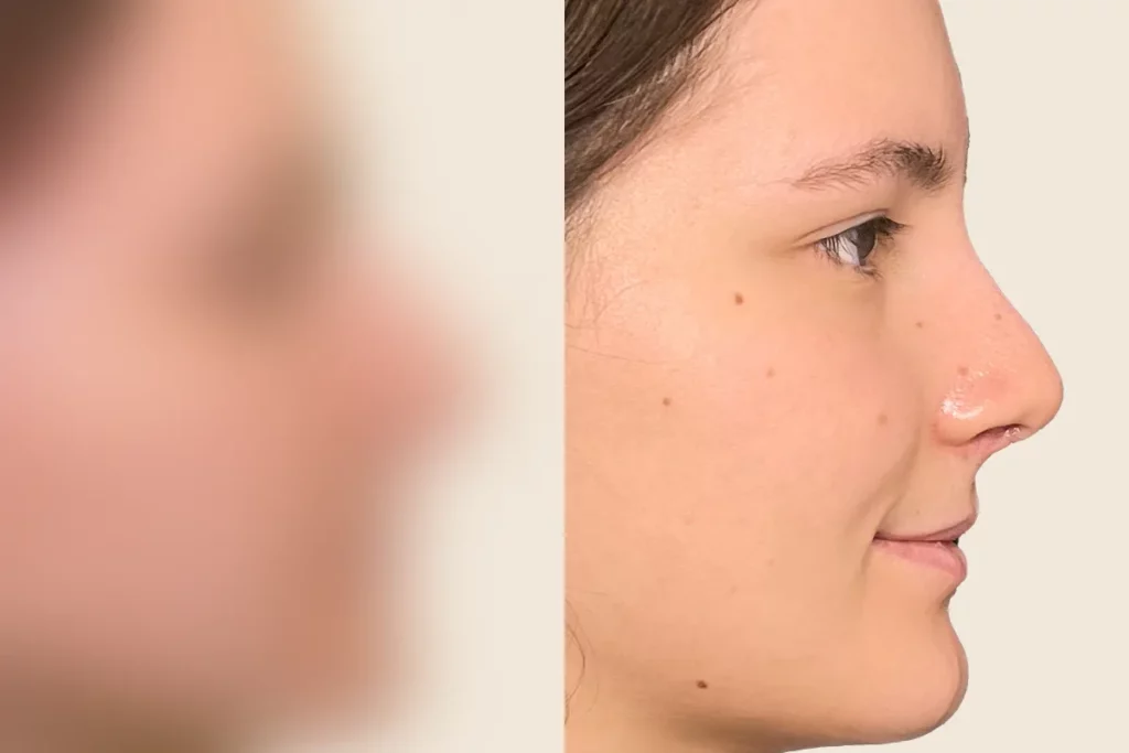 Profile photo of a patient after rhinoplasty.