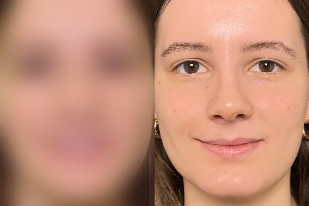 Portrait of a patient after rhinoplasty.