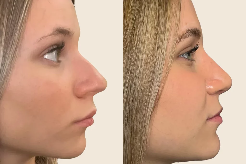Profile photos of a patient after rhinoplasty in before and after comparison.