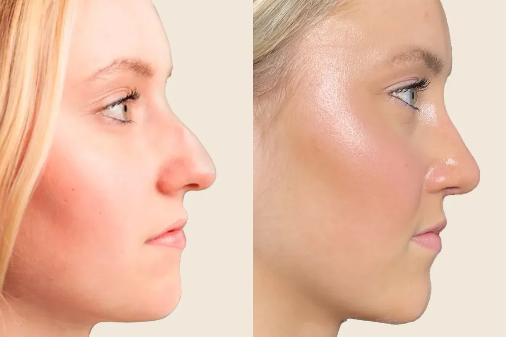Profile photos of a patient after rhinoplasty in before and after comparison.