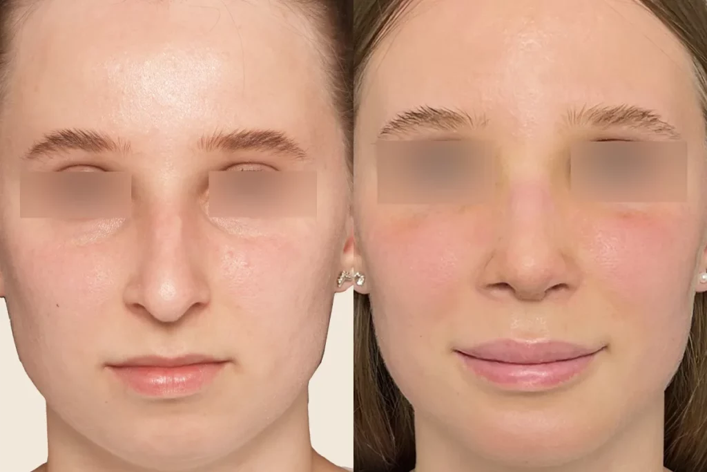 Portraits of a patient before and after rhinoplasty.