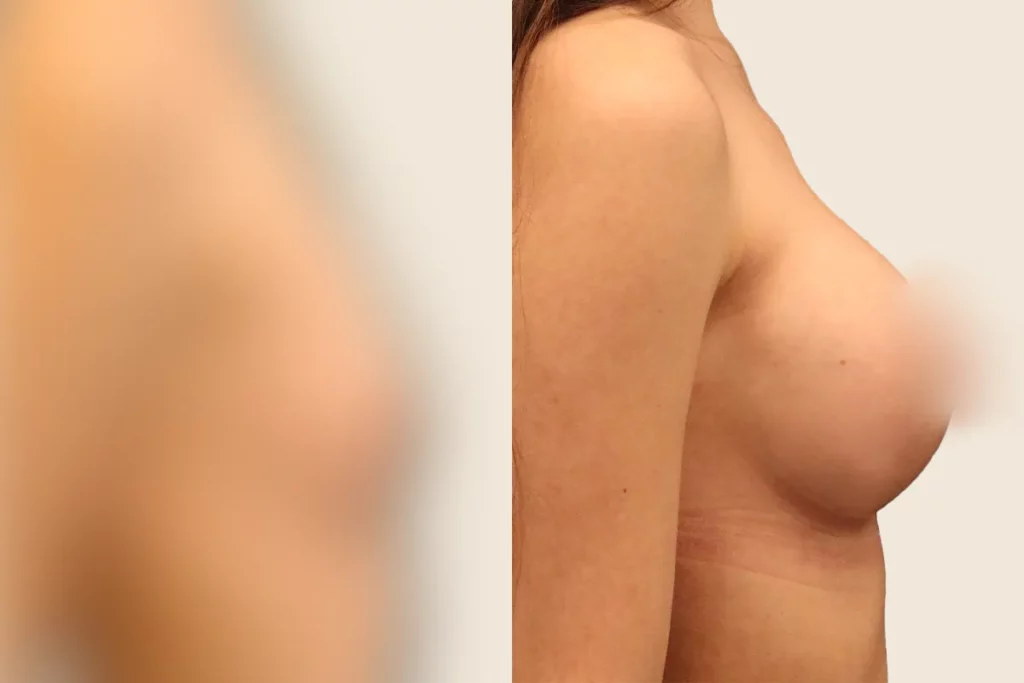 Lateral image of a patient's breast after breast augmentation.