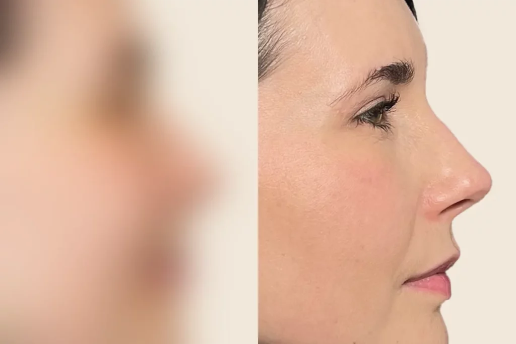 Profile photo of a patient after an eyelid lift.