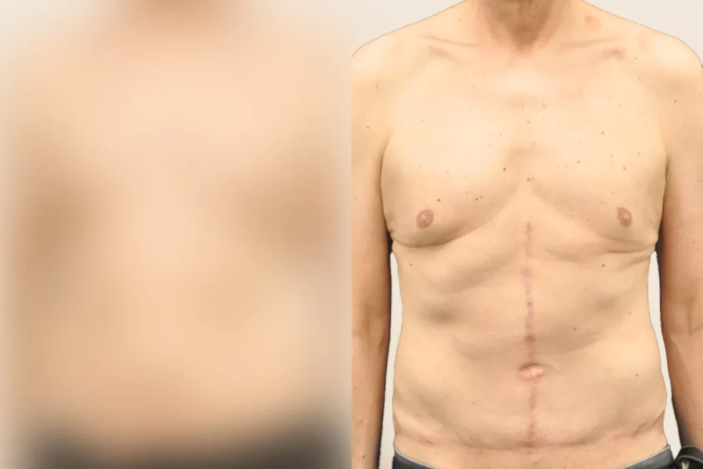 Upper body of a patient after a tummy tuck.