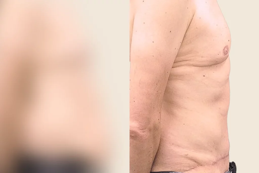 Side view of a patient's upper body after a tummy tuck.