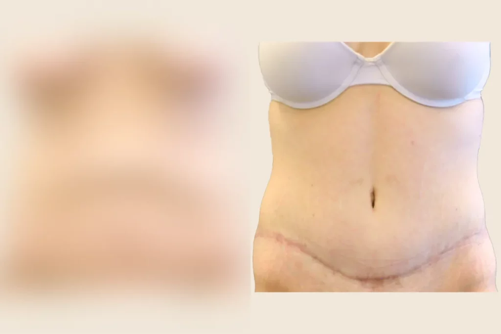 Upper body of a patient after a tummy tuck.