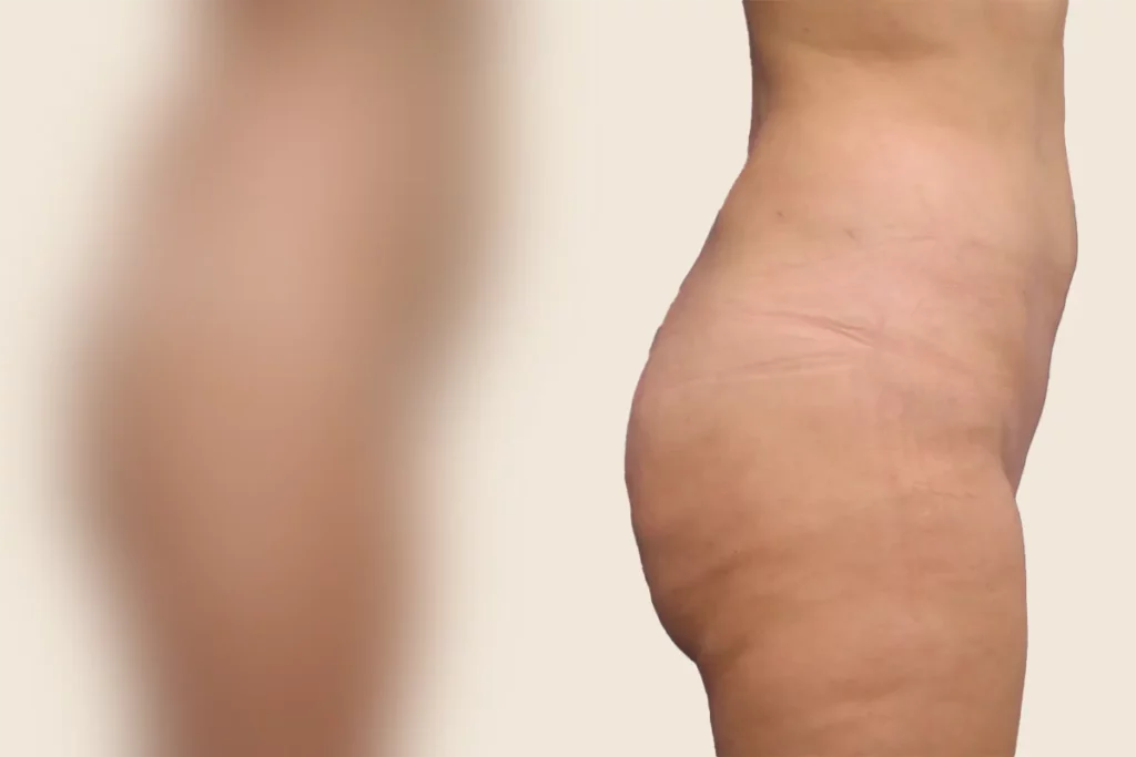 Lateral images of the bottom after a Brazillian Butt Lift.
