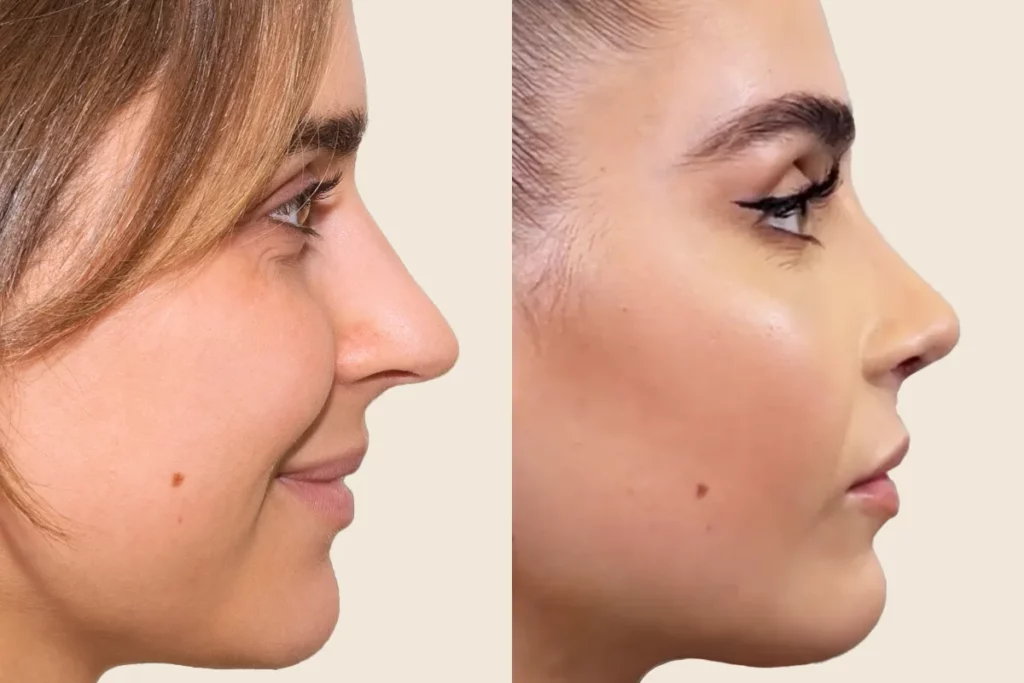 Profile photos of a patient after rhinoplasty in before and after comparison.