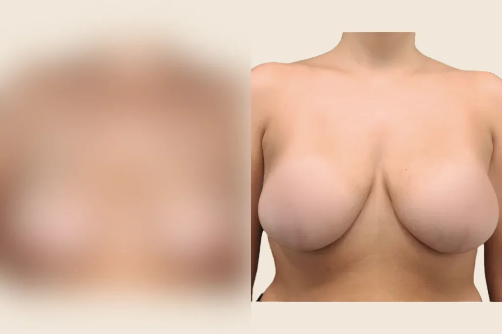 Breast after breast lift.