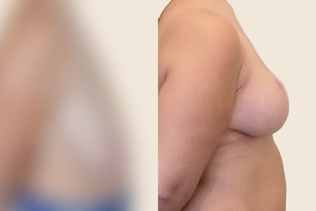 Lateral image of a patient's breast after breast lift.