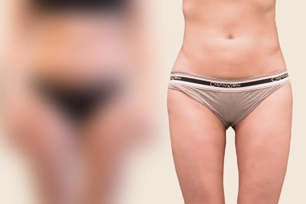 drberkei before after 36 2