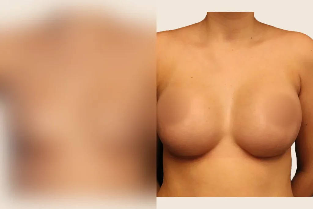 Breast after breast augmentation.
