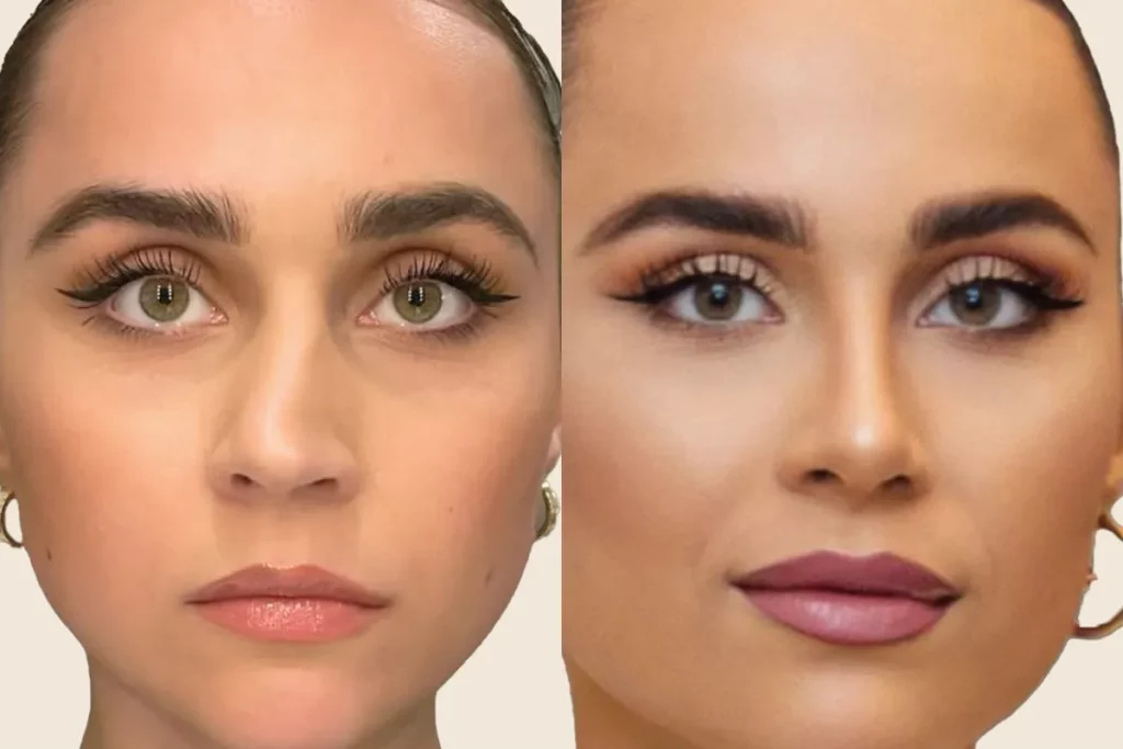 drberkei before after 4