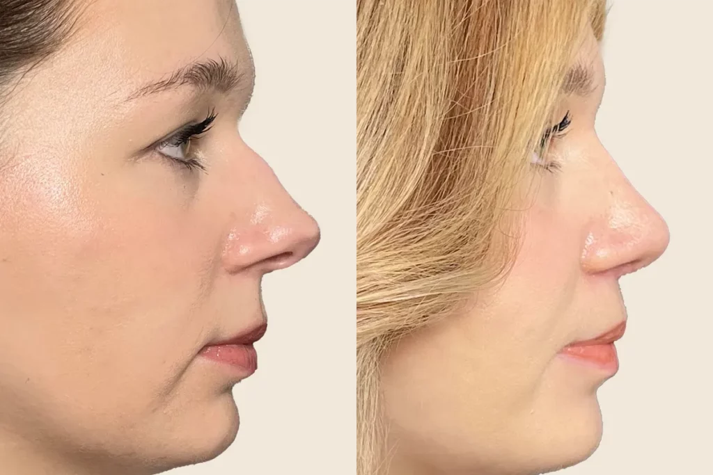 drberkei before after 5