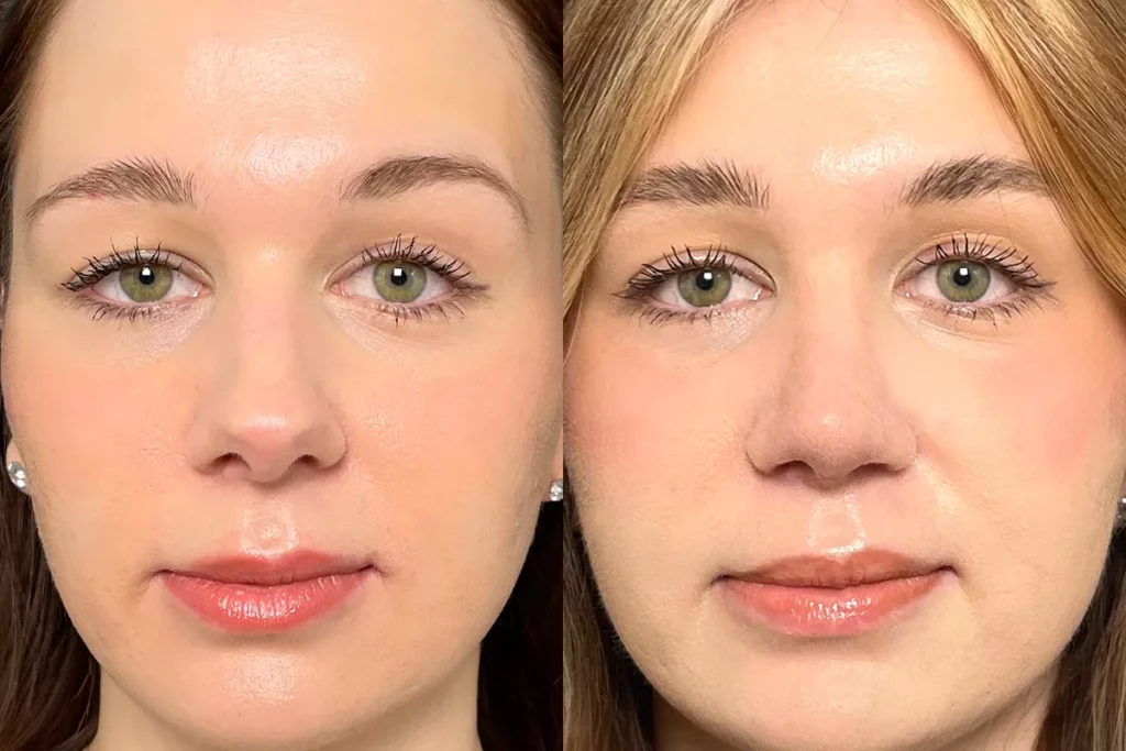 drberkei before after 6