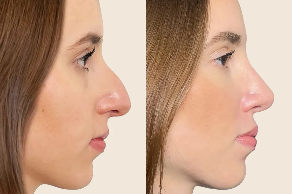 drberkei before after 7