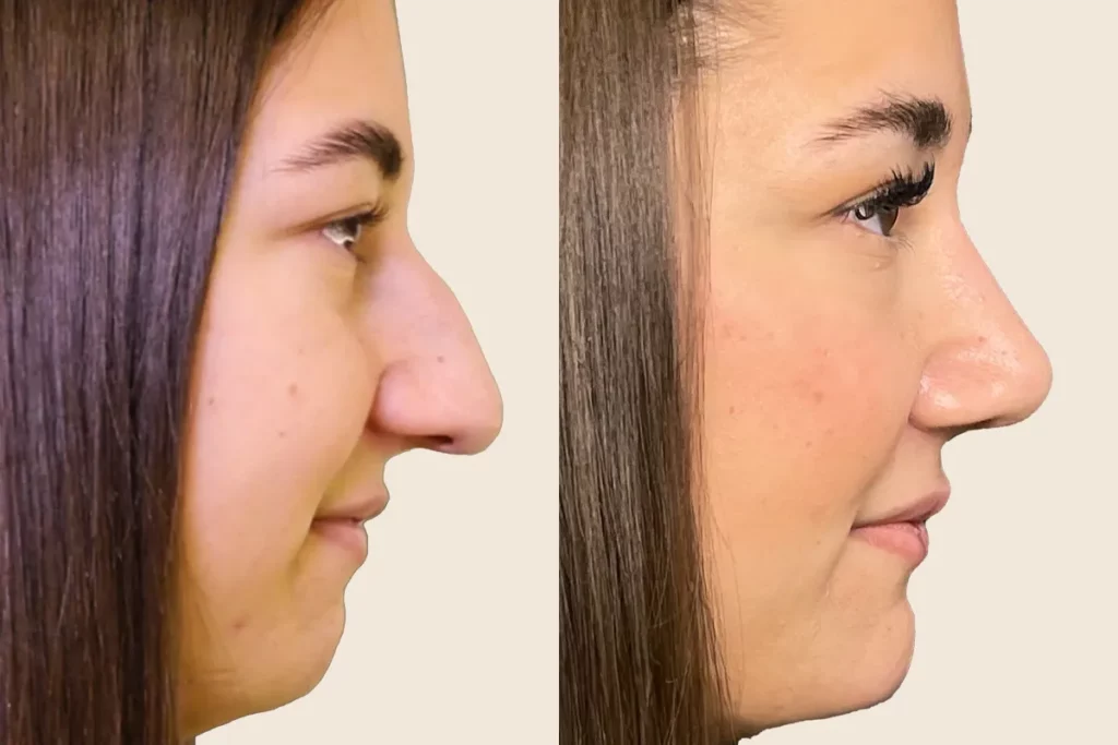 drberkei before after 8