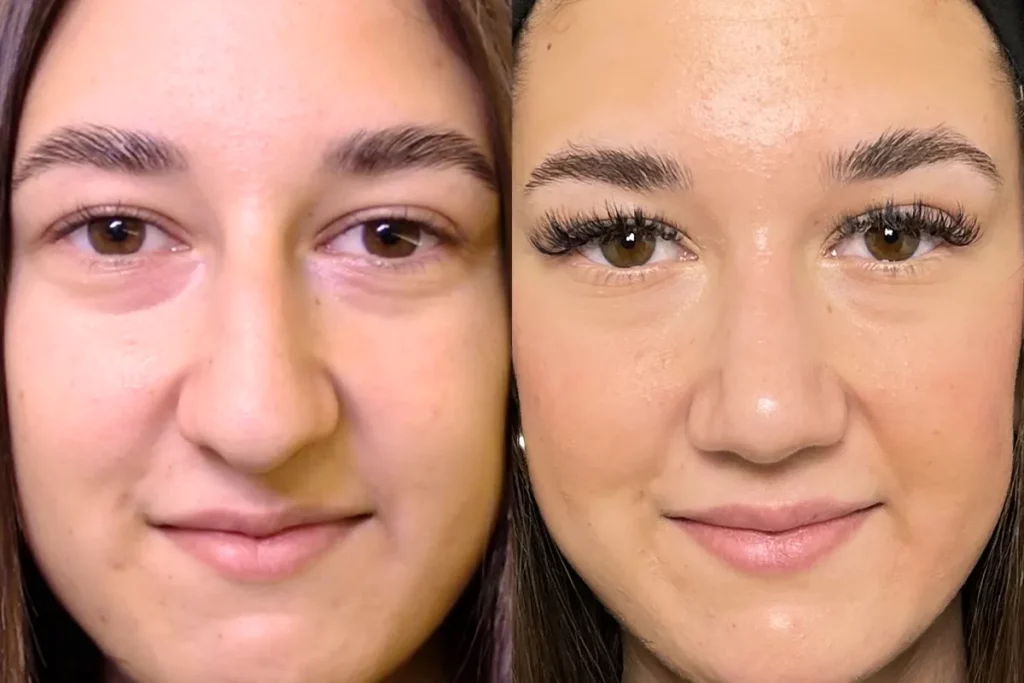 drberkei before after 9