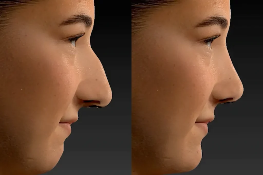 drberkei before after simulation 1