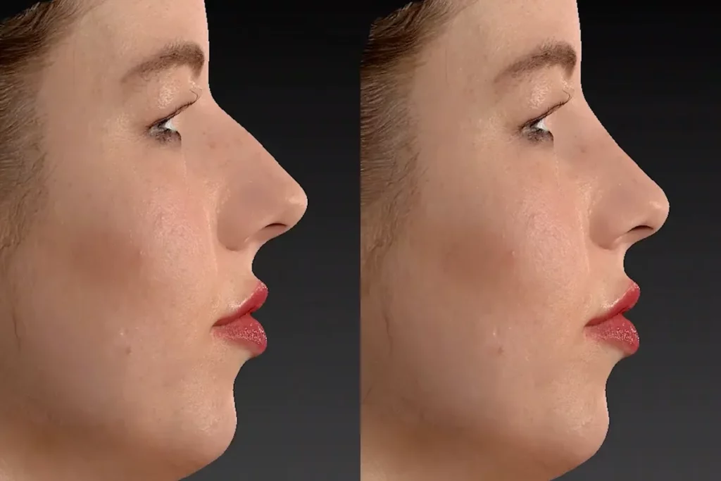 drberkei before after simulation 3