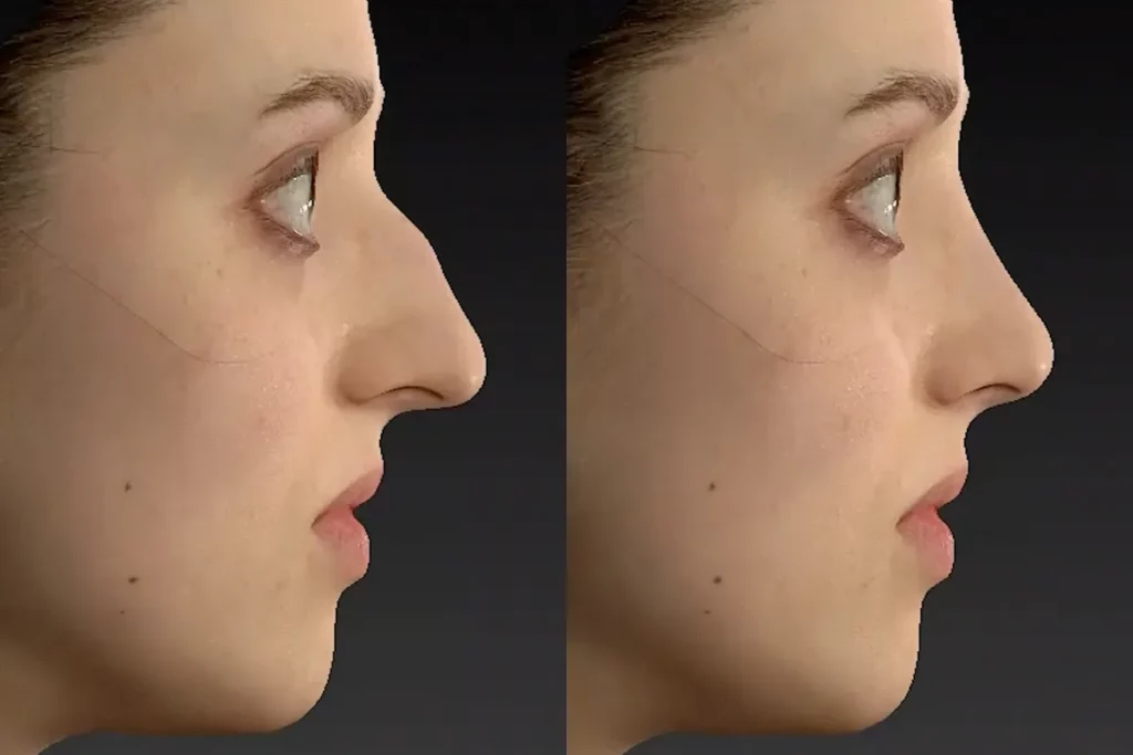 drberkei before after simulation 4