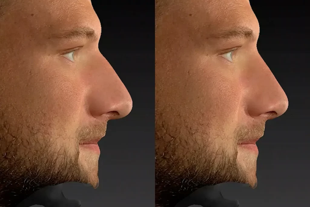 drberkei before after simulation 5