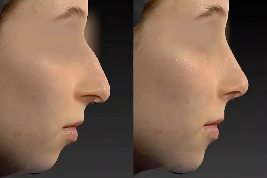 drberkei before after simulation 6