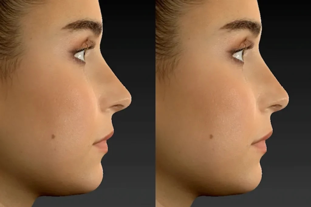 drberkei before after simulation 7